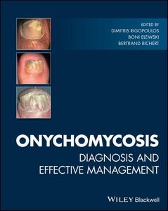 Onychomycosis: diagnosis and effective management